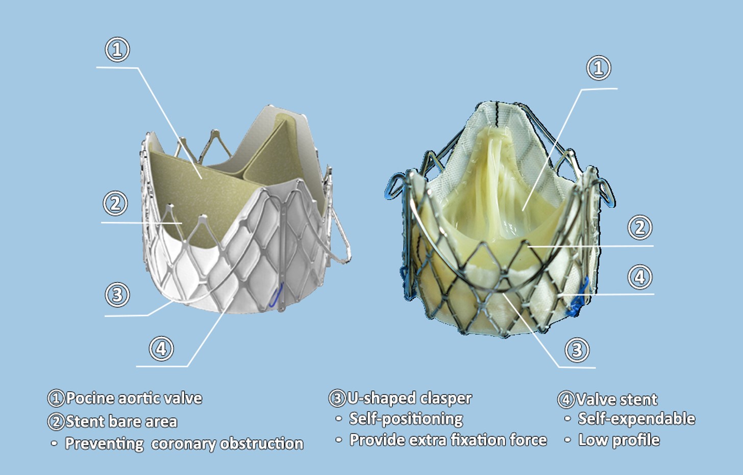 4VIV-TMVR手术中使用的J Valve瓣膜形态.jpg